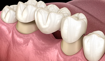 A 3D illustration of a traditional dental bridge