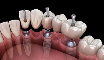 A 3D illustration of an implant bridge being placed