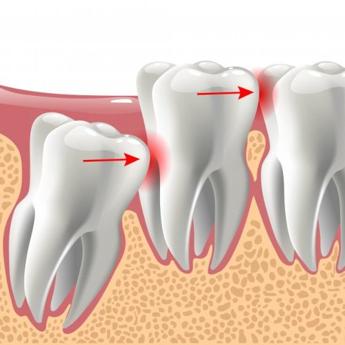 Illustration of impacted molar